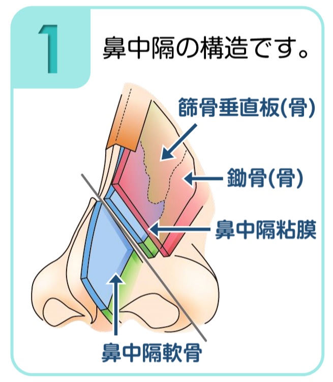 鼻中隔湾曲症 手術