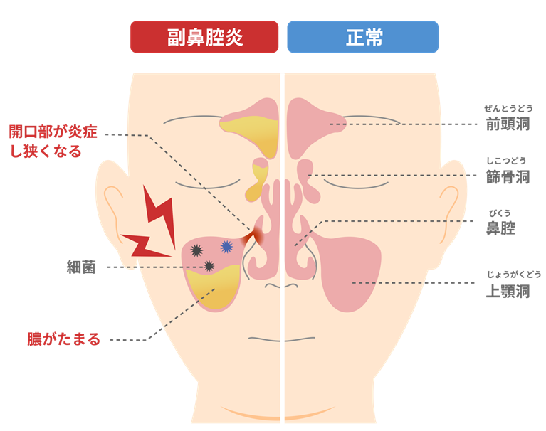 副鼻腔炎